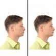 rhinoplastie enfant